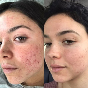 Máscara facial LED